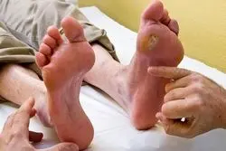 زخم دیایتی: مزایا و معایب درمان خانگی زخم دیابتی