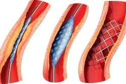 تفاوت های بالن و فنر قلب مزایا و معایب هر کدام