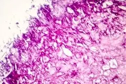 کشف بزرگ دانشمندان برای درمان سرطان