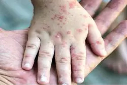 نهضت ضدواکسن سرخک را برمی‌گرداند