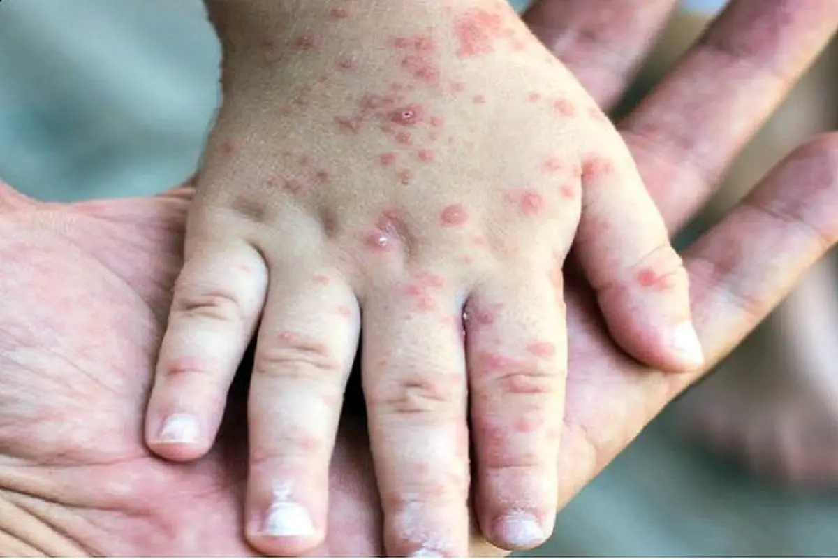 نهضت ضدواکسن سرخک را برمی‌گرداند