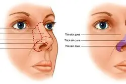عمل بینی غضروفی با پوست نازک چیست