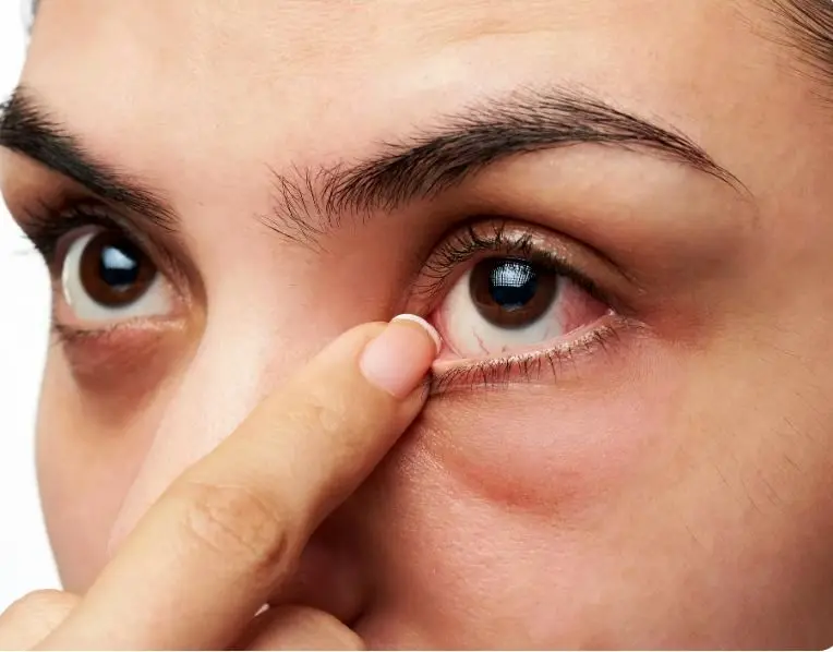 چه افرادی در معرض ابتلا به خشکی چشم هستند؟