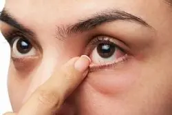 چه افرادی در معرض ابتلا به خشکی چشم هستند؟