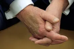 کبودی روی دست ترامپ خبرساز شد/ بیماری رییس جمهور آمریکا چیست؟