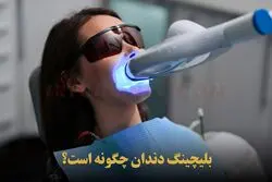 بلیچینگ دندان یا سفید کردن دندان + هزینه و طول عمر