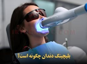 بلیچینگ دندان یا سفید کردن دندان + هزینه و طول عمر