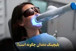 بلیچینگ دندان یا سفید کردن دندان + هزینه و طول عمر