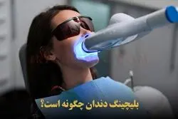 بلیچینگ دندان یا سفید کردن دندان + هزینه و طول عمر