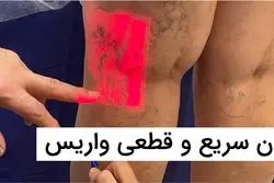 درمان واریس: خداحافظی با درد و ناراحتی، سلام به زیبایی و آرامش