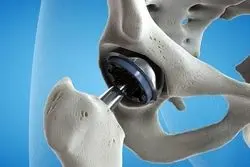 اندازه بازار جهانی لوازم ارتوپدی چقدر است؟