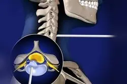 جراحی دیسک گردن با لیزر در کرج: متخصصان، مراکز و هزینه‌ها
