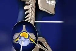 جراحی دیسک گردن با لیزر در کرج: متخصصان، مراکز و هزینه‌ها