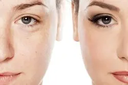 چند روز بعد از میکرودرم و میکرونیدلینگ پوست خوب میشه؟