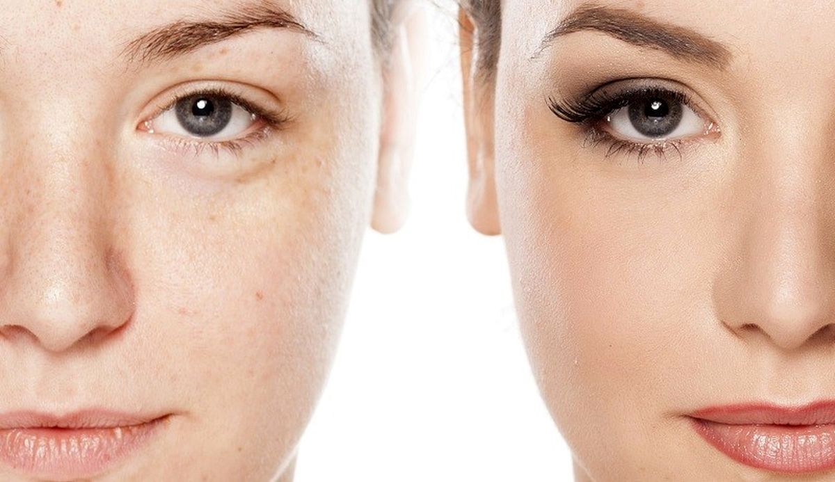چند روز بعد از میکرودرم و میکرونیدلینگ پوست خوب میشه؟