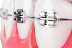 قیمت ارتودنسی دندان چگونه محاسبه می شود؟