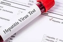 غربالگری هپاتیت در معتادان تحت درمان از اواخر شهریور؛ درمان رایگان هپاتیت در کشور