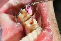 عصب‌کشی با تعرفه دولتی آغاز شد؛ دندان‌هایتان را ارزان‌تر درمان کنید