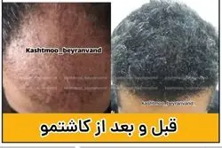 راهنمای انتخاب بهترین کلینیک برای کاشت مو